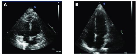 left ventricular hypokinesis treatment.